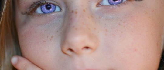 Síndrome de Alejandría: la "rara condición" de los ojos violetas