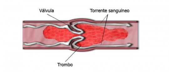 Embolia cerebral: tipos, síntomas, secuelas y causas