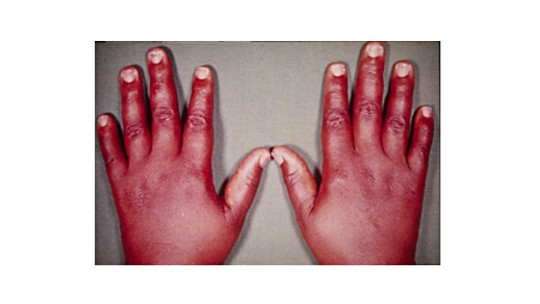Mixedema