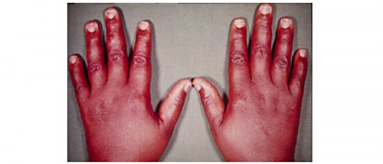 Mixedema