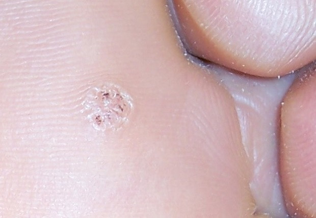 Verrugas plantares