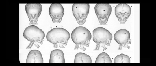 Craneosinostosis: tipos, causas y tratamiento
