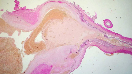Los tipos de aneurisma