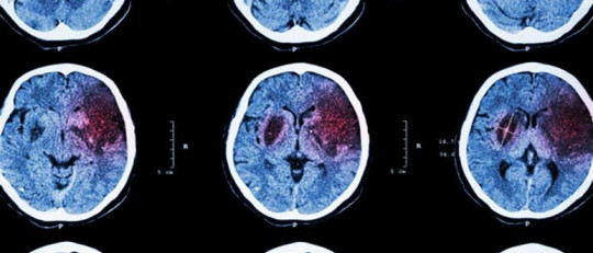 Derrame cerebral: definición, causas, síntomas y tratamiento