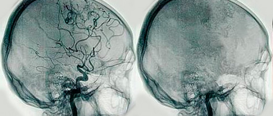 Angiografía cerebral: ¿qué es y qué trastornos permite detectar?
