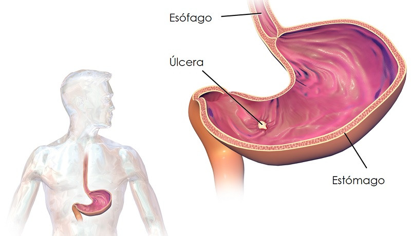 Úlcera