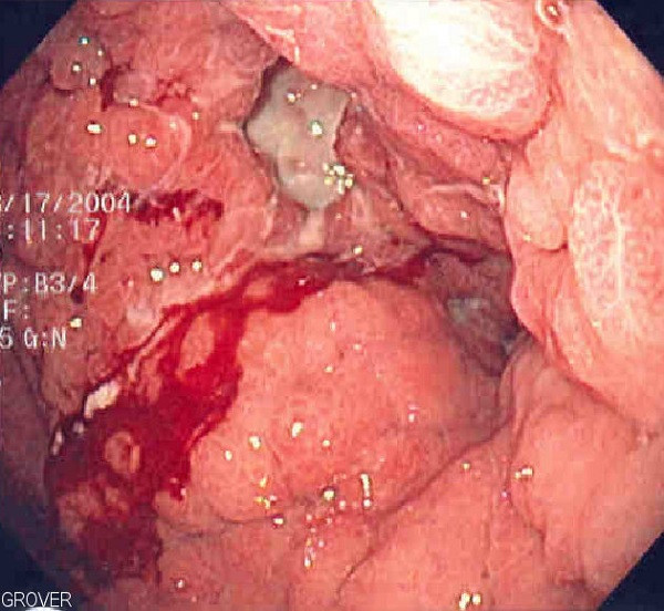 Cáncer de estómago