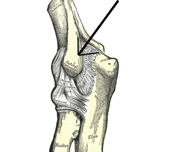 Epicondilitis