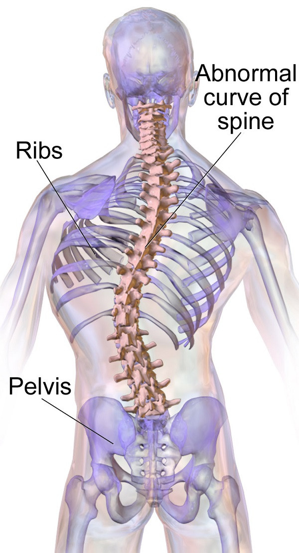 Escoliosis
