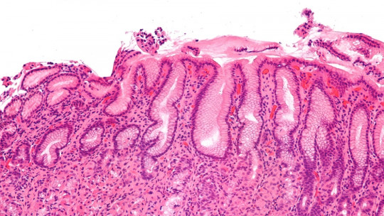 Diferencias entre gastritis y gastroenteritis