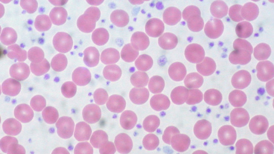 Trombocitopenia