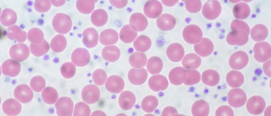 Trombocitopenia