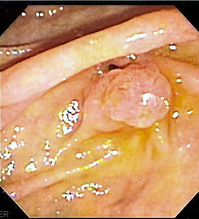 Ampolla de Vater