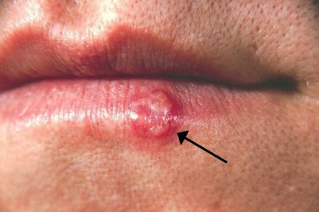 Herpes labial