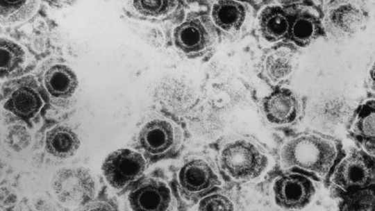 Tipos de herpes